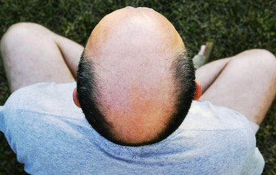 Six Ways to Reduce Hair Loss in Men